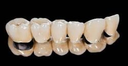 Porcelain Dental Crowns And Bridges