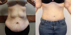 Tummy Tuck Before and After Pictures