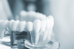 Dental Implant Specialist in Cypress, TX