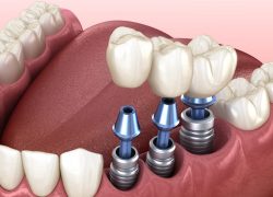 Dental Implant Specialist in Houston, TX