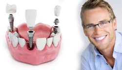 Affordable Dental Implants in Houston