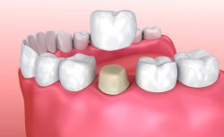 Affordable Dental Crowns Near Me