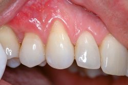 Gum Recession Treatment in Houston