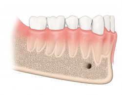 Gum Regeneration Treatment in Houston