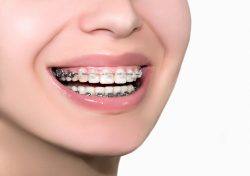 Affordable Dental Braces Near Me