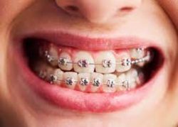 Affordable Dental Braces Near Me