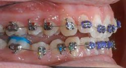 Braces power chain colors