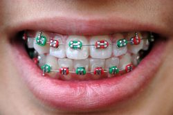 Best Braces Color Ideas