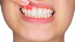 Laser Treatment For Gum Disease | Treatment of Gum Disease