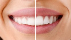 Laser Treatment For Gum Disease | Treatment of Gum Disease