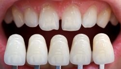 Different Types Of Veneers