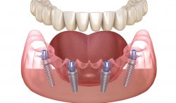 All On 4 Dental Implants Near Me