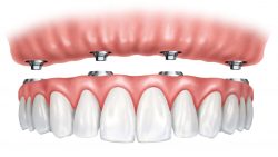 All On 4 Dental Implants Near Me