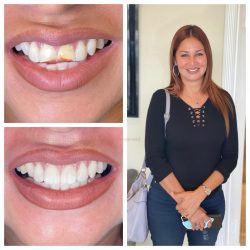 All On 4 Dental Implants in Aventura