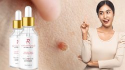 Amarose Skin Tag Remover Review (USA): Does It Work? Urgent Customer Update!