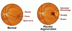 Ayurvedic ARMD Treatment