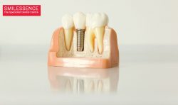 Best Dental Implants in Gurgaon