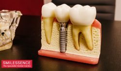 Best Dental Implants Services in Gurgaon