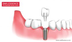 Implants Clinic For Dental Implants in Gurgaon