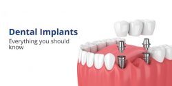 Dental Implant Treatment In Jaipur