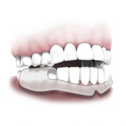 Mouth Guard for Night-time Teeth Grinding