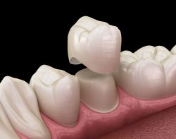 What Is There To Know About Dental Crowns?