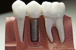 What Is There To Know About Dental Crowns?