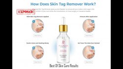 Amarose Skin Tag Remover Reviews