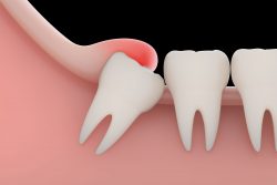 Wisdom Teeth Removal in Miami, FL