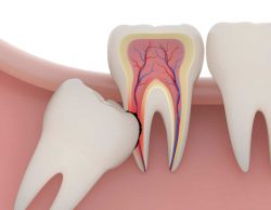 Wisdom Teeth Removal Cost in Miami, FL