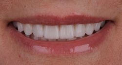 Dental Veneers Specialist In Houston