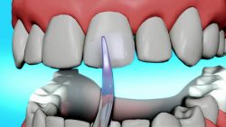 Dental Bonding Procedure