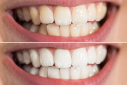 Teeth Whitening Dentist in Houston