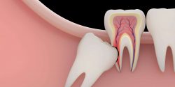 Wisdom Teeth Removal Near Me in Houston