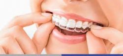 Invisalign Near Me Online Search