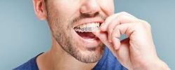 Types Of Permanent Retainer | Fixed Retainer | Replacement Retainer