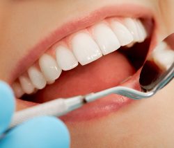 Professional Teeth Whitening Near Me In Houston, TX