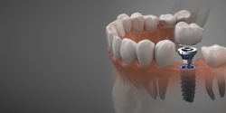 Affordable Dental Implants in Houston TX