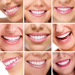 Cosmetic Dentistry Veneers