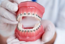 Invisalign Treatment in Houston, TX