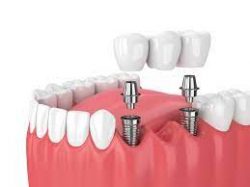 Dental Tooth Crown Procedure In Houston, Tx