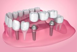 Dental Crowns Before And After The Procedure