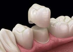 Best Dental Implant Near Me In Houston, Tx