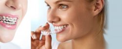 Affordable Dental Braces Near Me