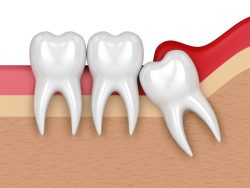 Infected Wisdom Tooth Extraction