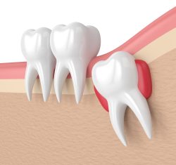 Dental Implants in Sunny Isles