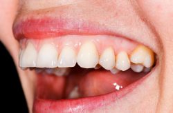 How To Get Healthy Gums Fast | Types of Gum Disease