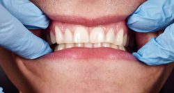 How To Get Healthy Gums Fast | Types of Gum Disease