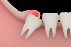 Erupted Wisdom Teeth Removal Cost | Wisdom Teeth Cause