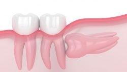 Impacted Wisdom Teeth Extraction Near Me | Extract Wisdom Teeth